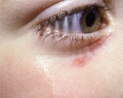 Fever, Conjunctival Injection, and a Facial Papule