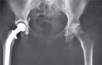 Hip Pain in an 80-Year-Old Woman