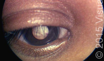 Pain and Changes in Appearance in a Child’s Eye