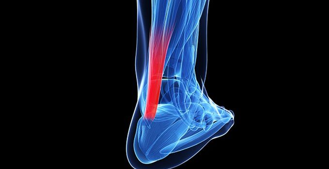 An Uncommon Mechanism for Work-Related Total Achilles Tendon Rupture