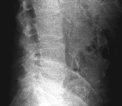 Abdominal Aortic Aneurysm (AAA)