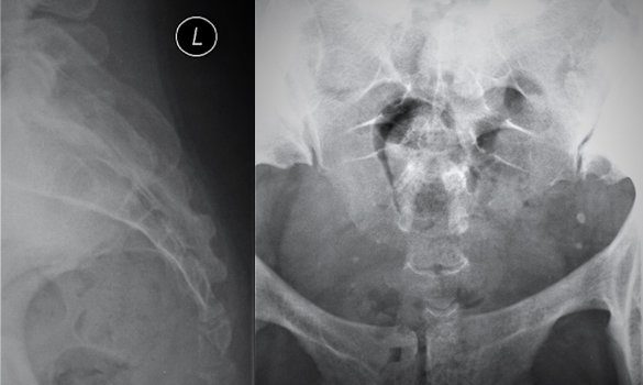 A Female with Coccyx Pain