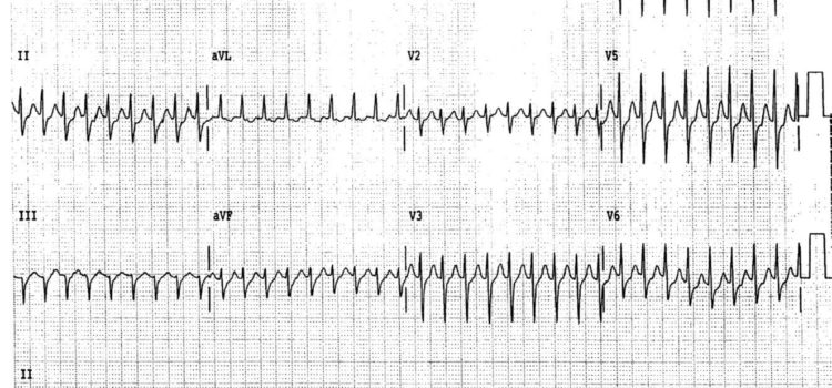 A 62-Year-Old Woman with Dizziness and Palpitations