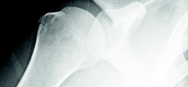 A 38-Year-Old Woman with Shoulder Pain