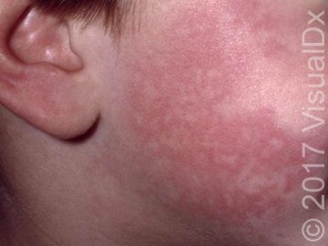 Unexplained Rash in a 3-Year-Old Girl