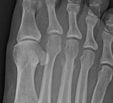 A Middle-Aged Man with Several Weeks of Midfoot Pain