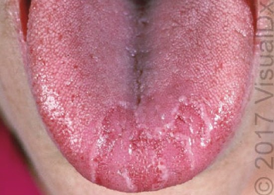 burning tongue image