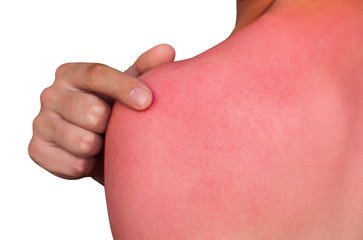 Consider What Else Might Be Going on with Sunburn Patients