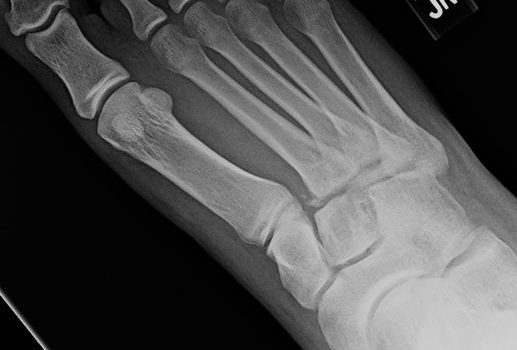 A 21-Year-Old Male with Foot Pain