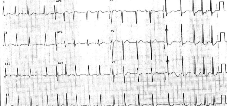 A 73-Year-Old Man with a 2-Week History of Palpitations