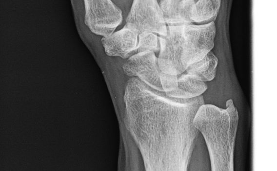 A 51-Year-Old Man with Wrist Pain After a Fall