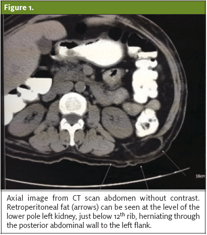 a) The superior lumbar triangle bordered by the 12th rib, internal