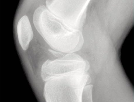 A 9-Year-Old Boy with Pain After Twisting His Knee