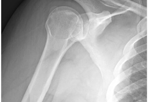 A 42-Year-Old Male with Worsening Chronic Shoulder Pain