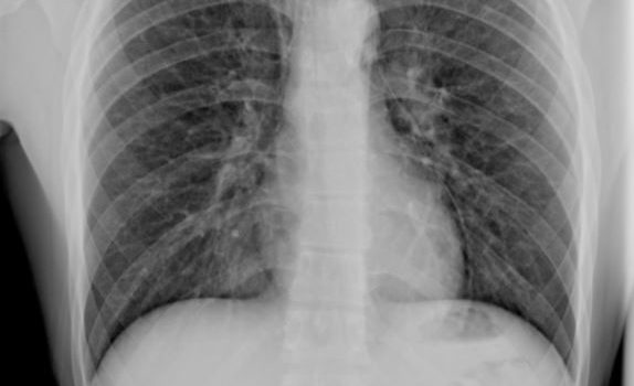 An 18-Year-Old Female with Sudden-Onset Chest Pain