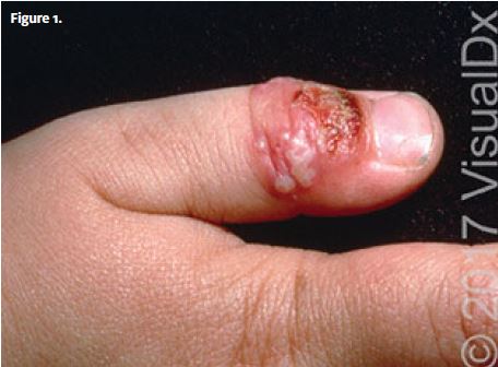 A 3-Year-Old with Lesions on His Thumb