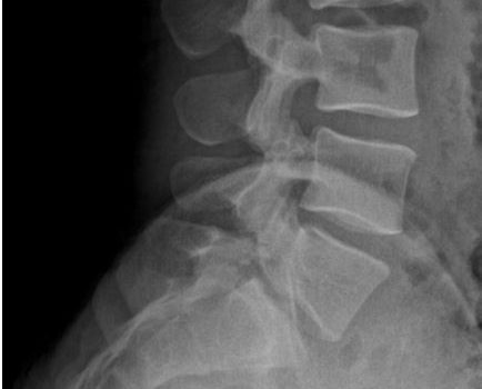 An 18-Year-Old Male with Chronic Back Pain