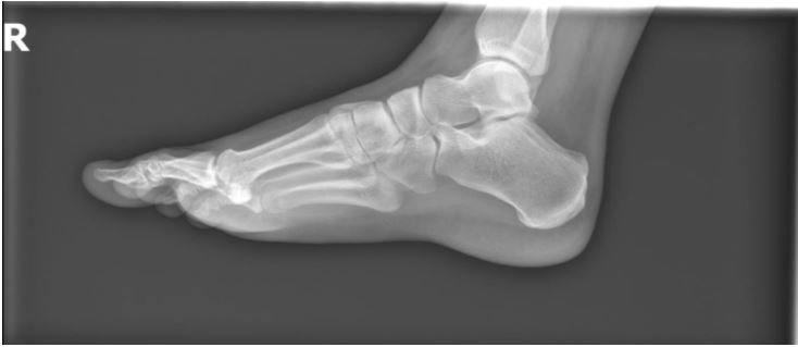 A Young Man with Acute Ankle Injury