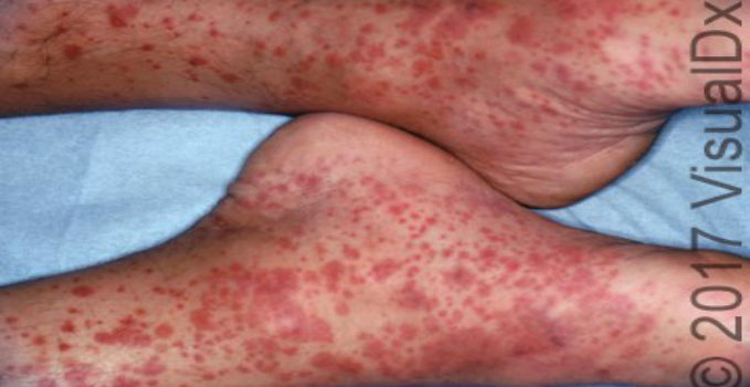 A 42-Year-Old Man with Skin Petechia and Palpable Purpura on His Legs