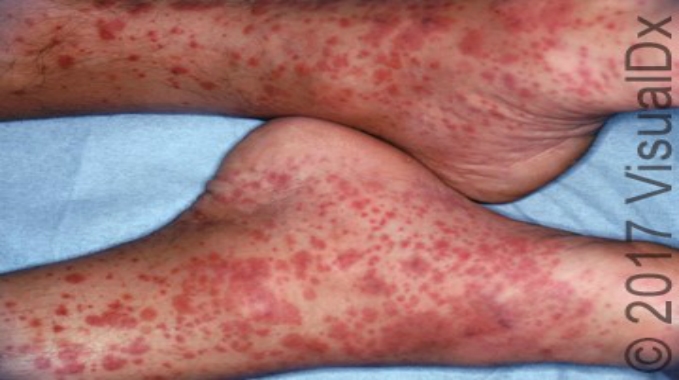 A 42 Year Old Man With Skin Petechia And Palpable Purpura On His Legs Page 2 Of 2 Journal Of Urgent Care Medicine A 42 Year Old Man With Skin Petechia And Palpable Purpura On His Legs Page 2 Of 2 Journal Of Urgent Care Medicine