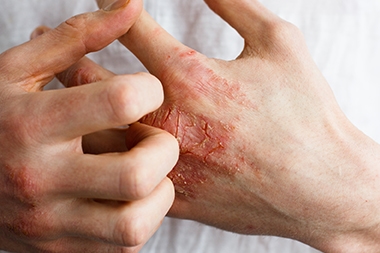 Eczema Patients Are Flocking to the ED—Could You Treat Them, Saving Time and Money?
