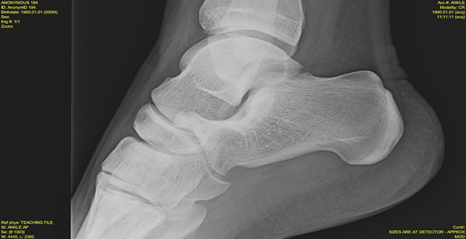 A 32-Year-Old Woman with Ankle Pain After a Fall