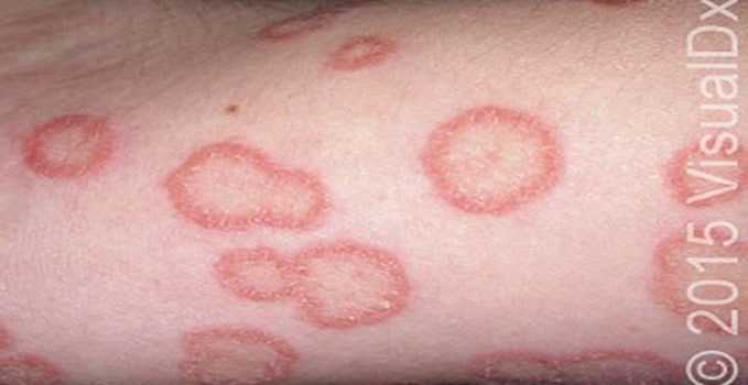 A 40-Year-Old Veterinarian with Scaly Lesions