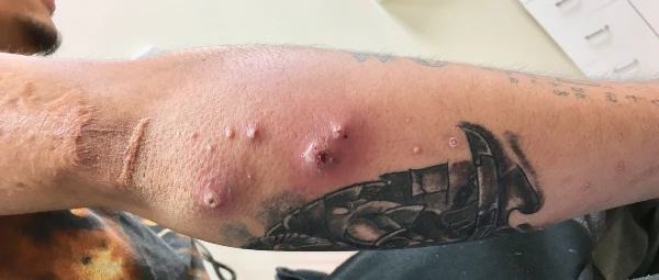 Right elbow with multiple abscesses 1 week after tattooing