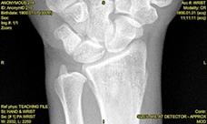 A 51-Year-Old Woman with Wrist Pain After a Fall