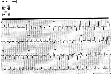 A 74-Year-Old Man with Epigastric Pain