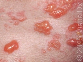 A 35-Year-Old HIV-Infected Patient