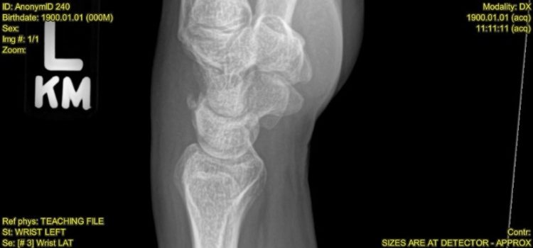 A 41-Year-Old Woman with Wrist Pain After Falling