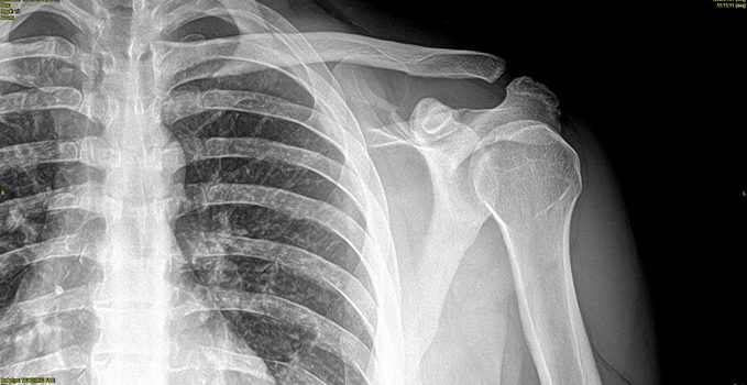 A 25-Year-Old Man with Shoulder Pain After a Fall