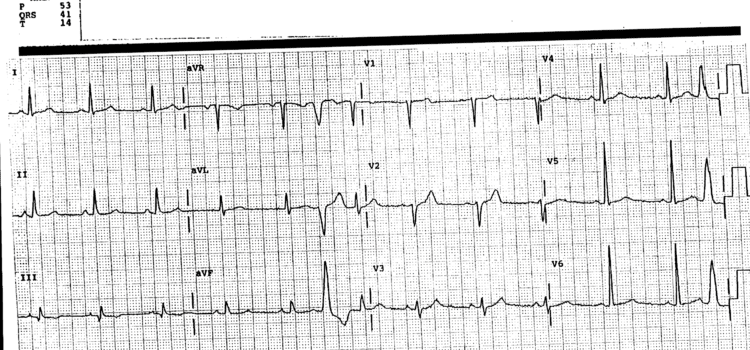 A 42-Year-Old Man with a ‘Flipping’ Sensation in his Heart