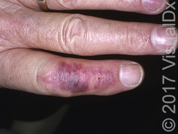 A 34-Year-Old Woman with an Unidentified Insect Sting