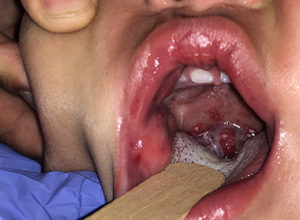 Fever and Drooling in Infants and Toddlers, Herpangina