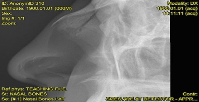 A 20-Year-Old Male with Nasal Pain Following an Injury