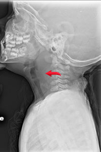 Fever and Drooling in Infants and Toddlers, prevertebral space widening