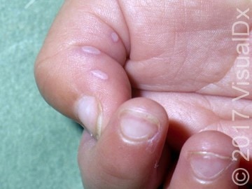 A 3-Year-Old Girl with Vesicles on Her Palms and Soles