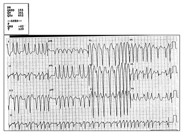 A 52-Year-Old Man with Recent-Onset Dizziness