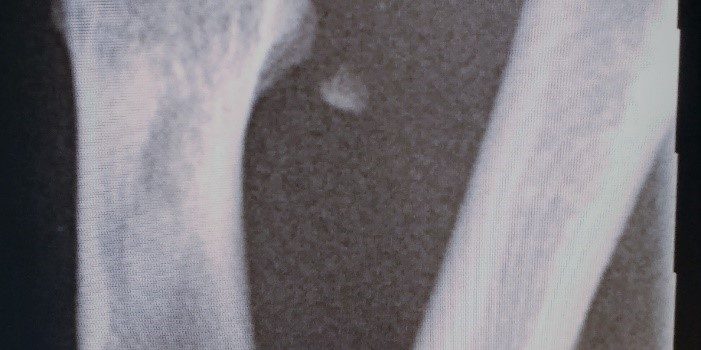 A 35-Year-Old Man with Thumb Pain After a Fall