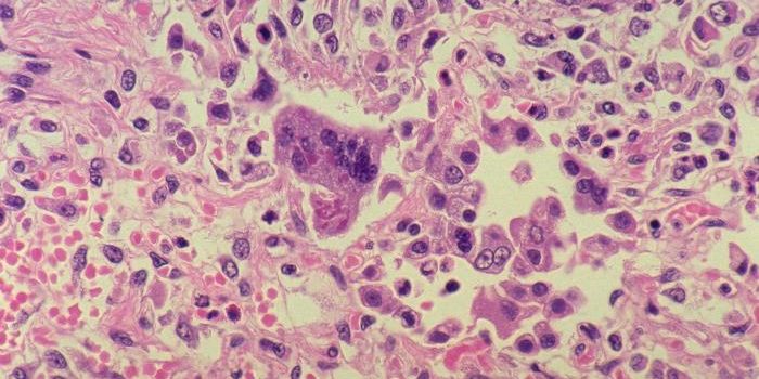 Add Measles to the List of Outbreaks on the Rise
