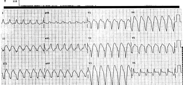 A 61-Year-Old Man Who Is Lightheaded and Dizzy