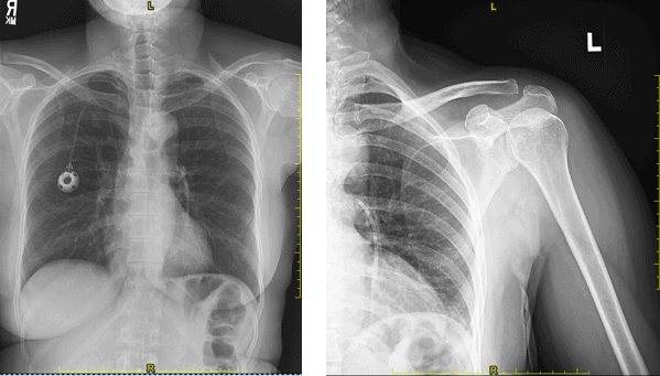 A 58-Year-Old Female with a New Infusion Port and Shoulder Pain
