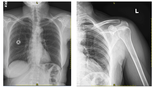 A 58-Year-Old Female with a New Infusion Port and Shoulder Pain A 58-Year-Old Female with a New Infusion Port and Shoulder Pain