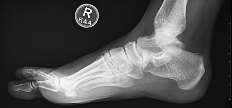 A Runner with a History of Foot Pain