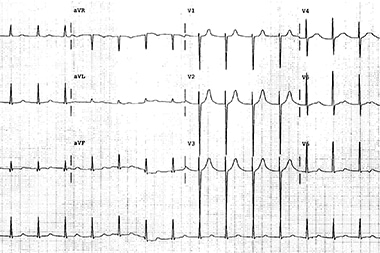 A 62-Year-Old Woman with Palpitations