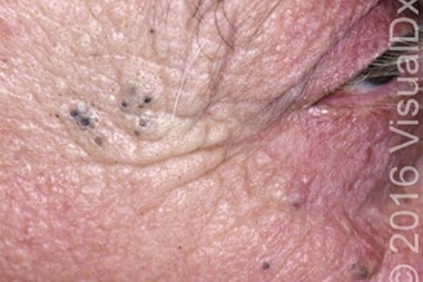 A 72-Year-Old Man with Black Skin Lesions