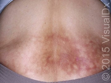 A 45-Year-Old Woman with Suddenly Discolored Skin