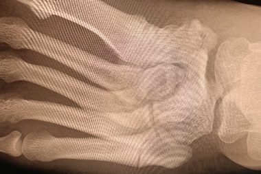 A 16-Year-Old with Severe Pain and Immobility After a Basketball Mishap